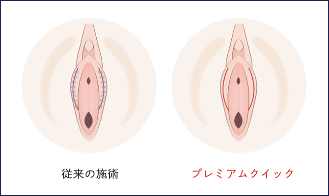 従来の施術 プレミアムクイック