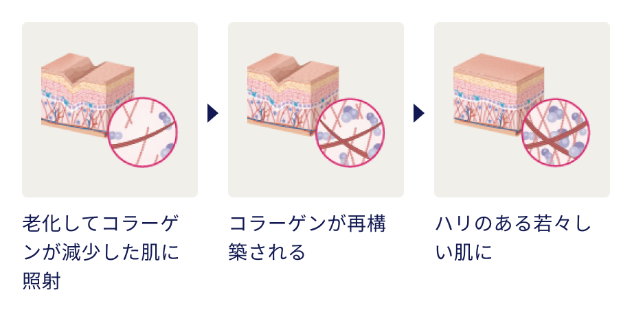 老化してコラーゲンが減少した肌に照射→コラーゲンが再構築される→ハリのある若々しい肌に