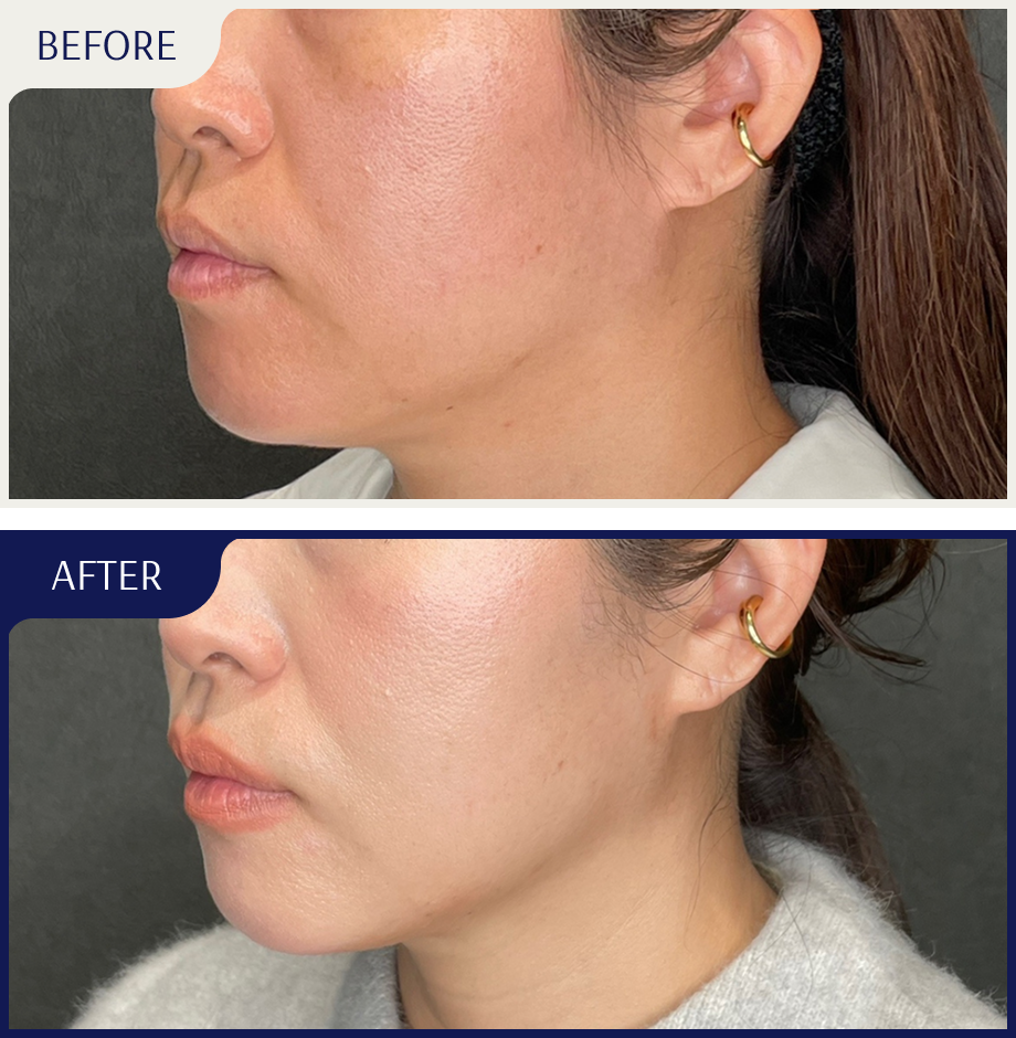 before after