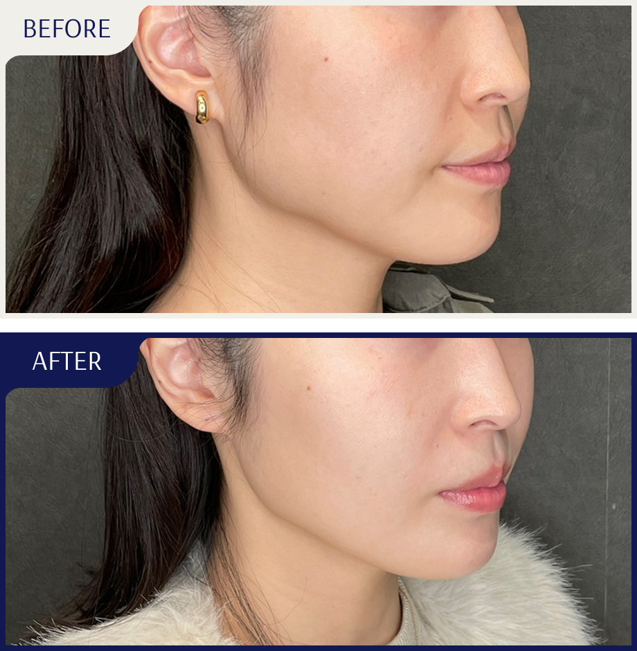 before after