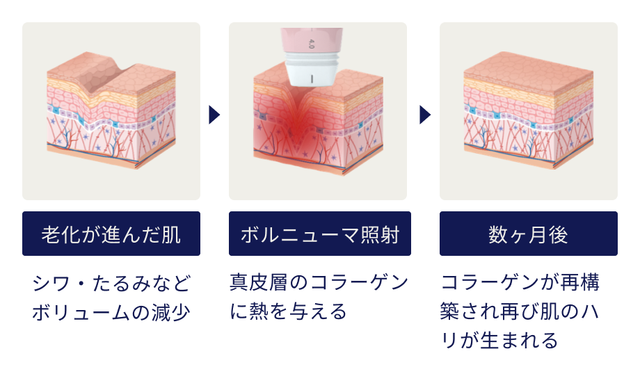 老化が進んだ肌 シワ・たるみなどボリュームの減少→ボルニューマ照射 真皮層のコラーゲンに熱を与える→数ヶ月後 コラーゲンが再構築され再び肌のハリが生まれる