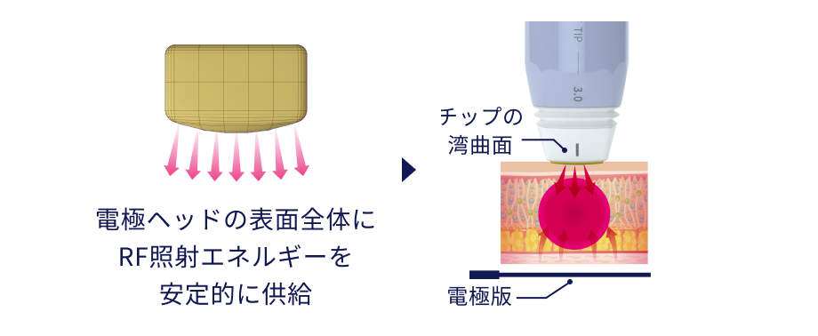 電極ヘッドの表面全体にRFエネルギーを安定的に供給→チップの湾曲面、電極版
