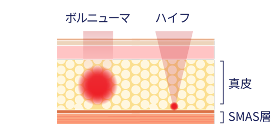 ボルニューマ、ハイフ、真皮、SMAS層