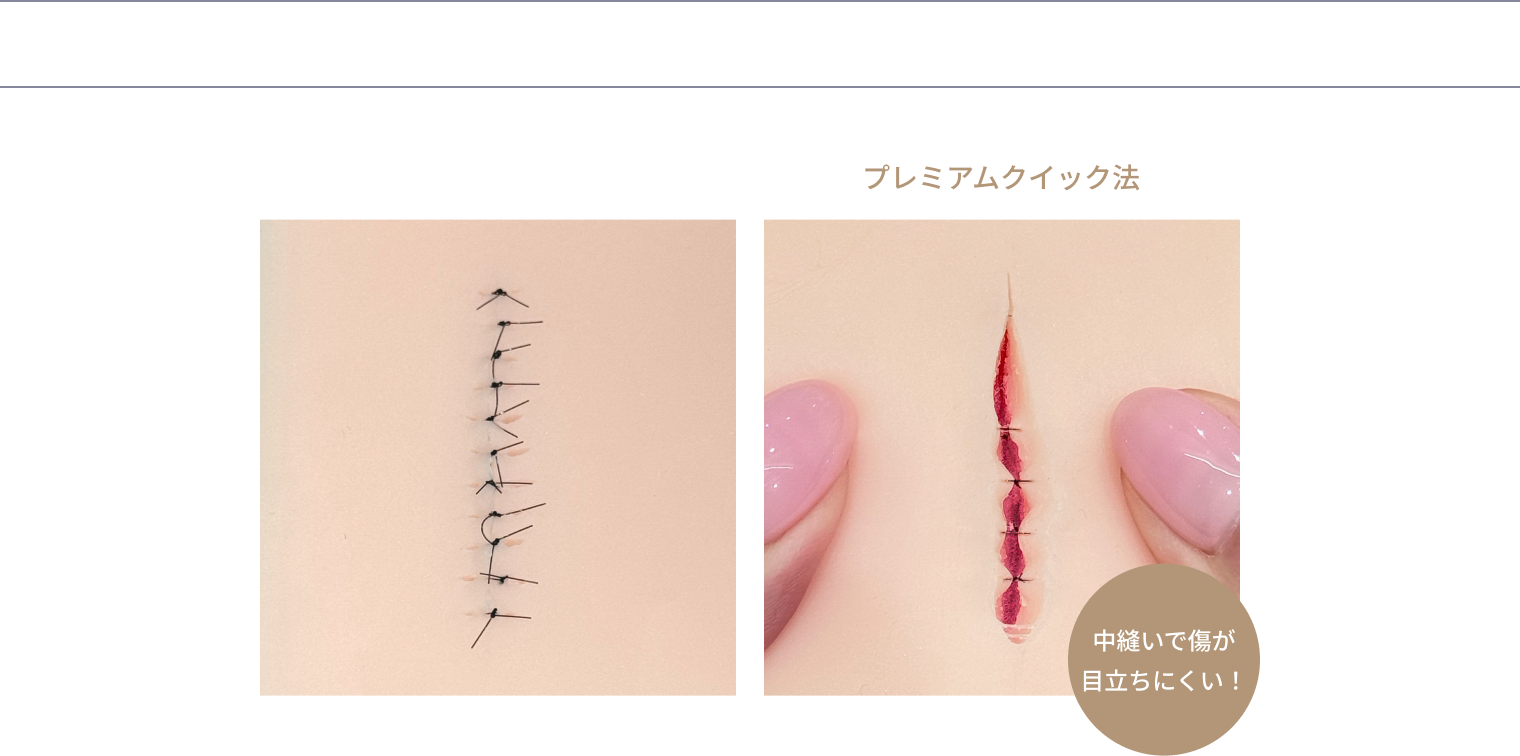 従来の縫合との違い