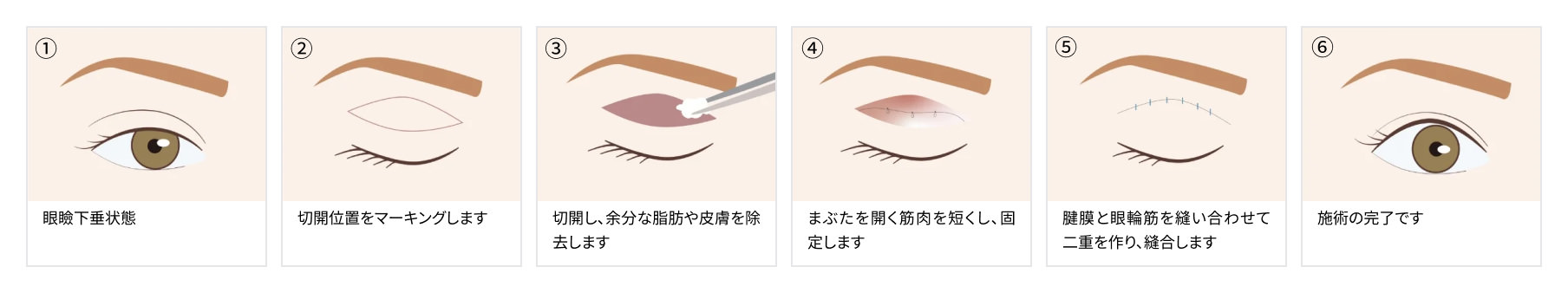 眼瞼下垂（切開法）