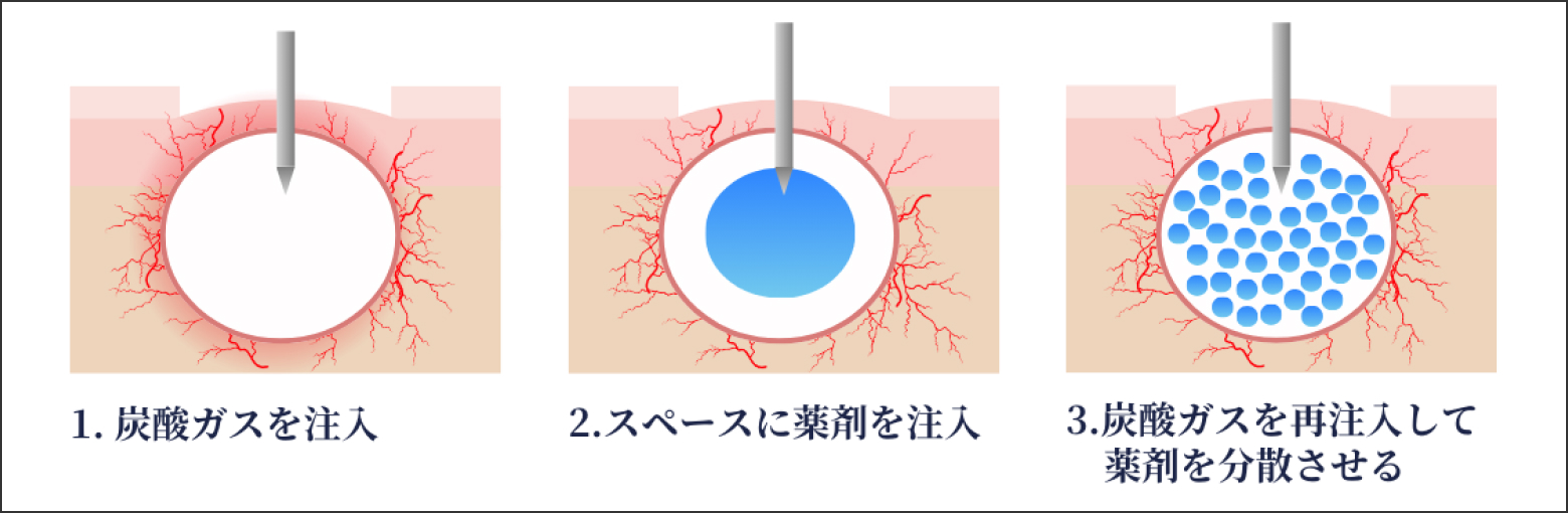 シミなどの元に、ピンポイントにアプローチ