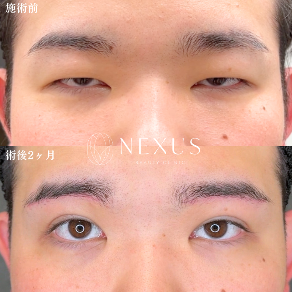ネクサスアイズ(二重埋没)+眉下切開+ROOF切除+眼高脂肪切除