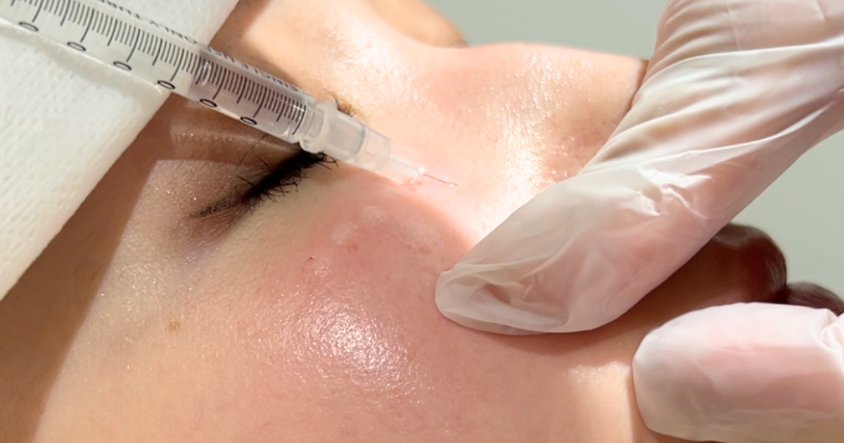 マイクロボトックス