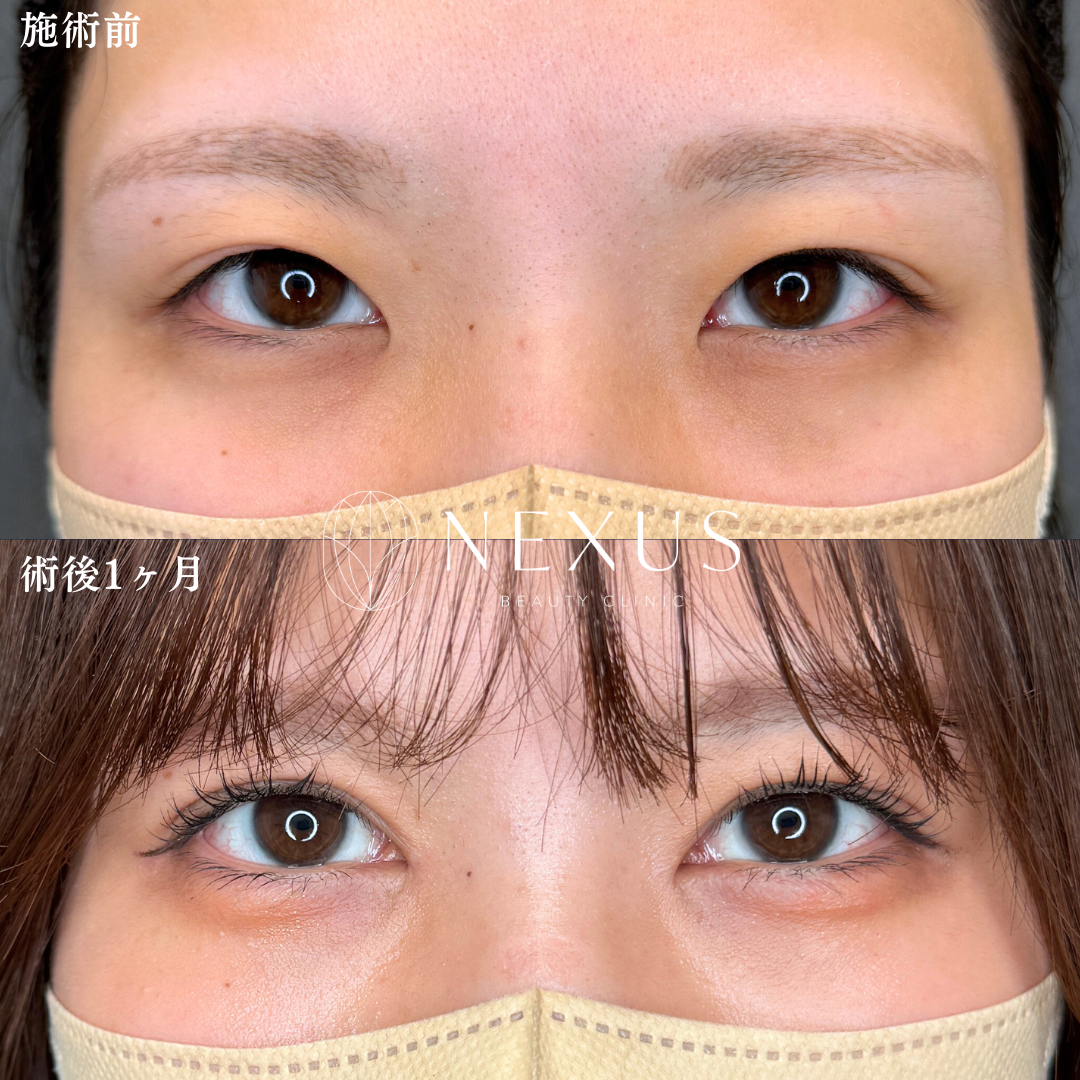 ネクサスアイズ(二重埋没)+目頭切開+まぶたの脂肪取り+きわ見せ 症例写真