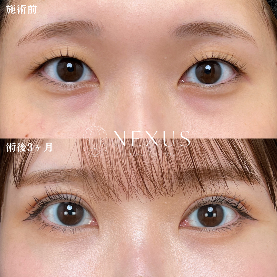 裏ハムラ 症例写真