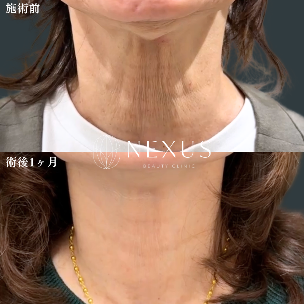 ボトックスリフト（中範囲）