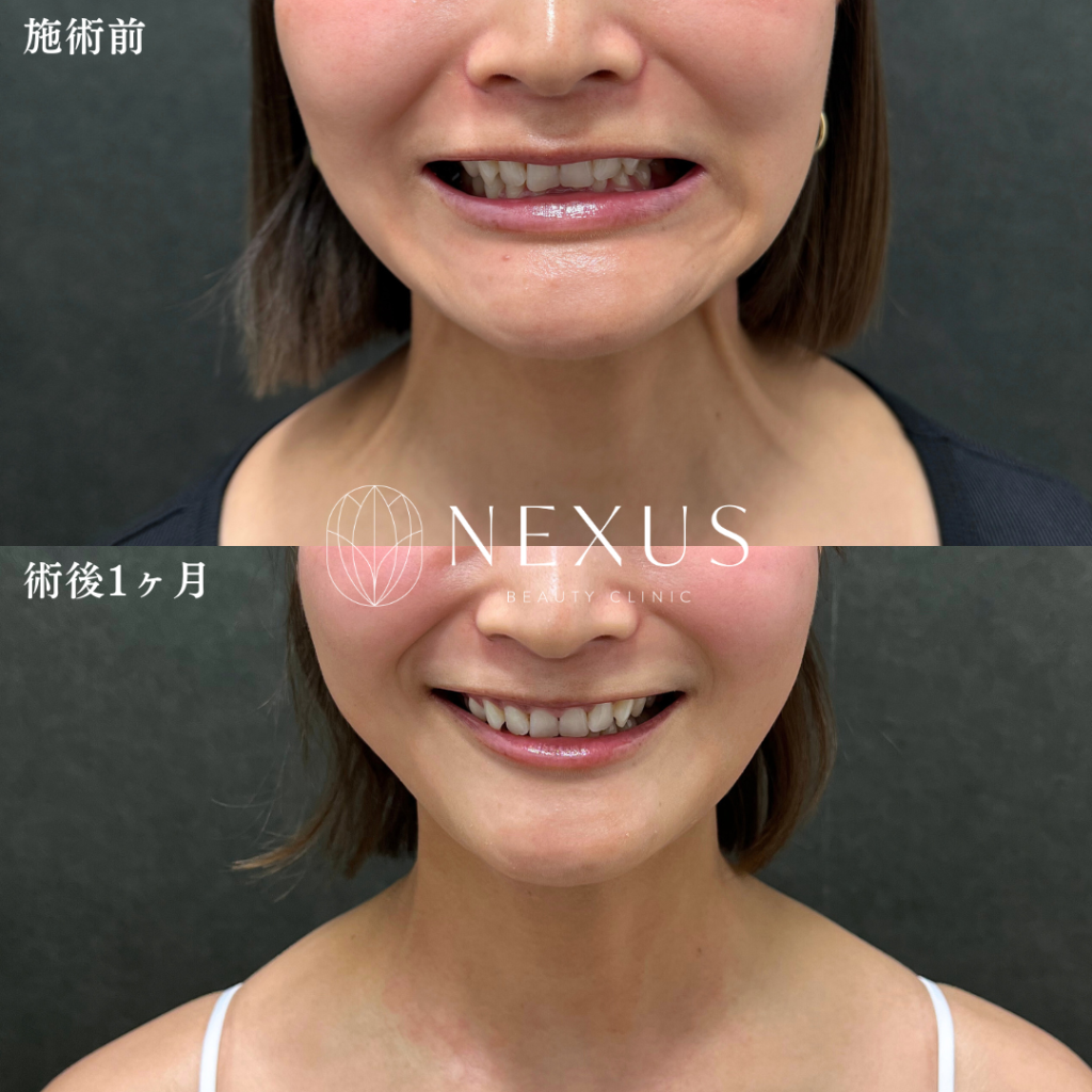 ボトックスリフト（中範囲）＋口角ボトックス