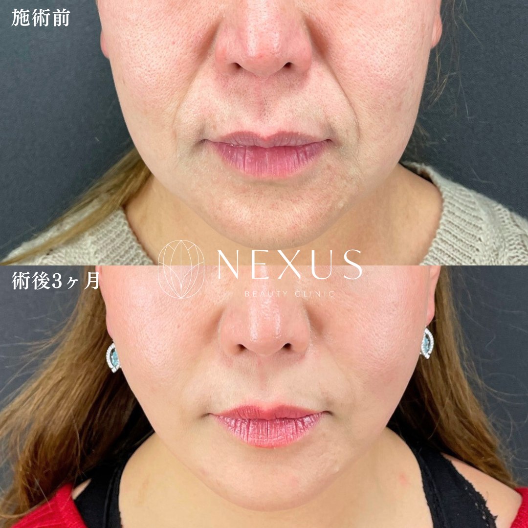 脂肪吸引(フェイスライン頬+あご下)+糸リフト(Basicコース) 症例写真