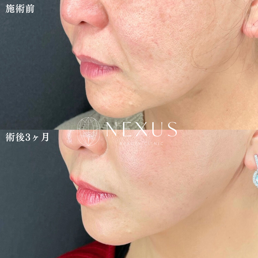 脂肪吸引(フェイスライン頬+あご下)+糸リフト(Basicコース) 症例写真