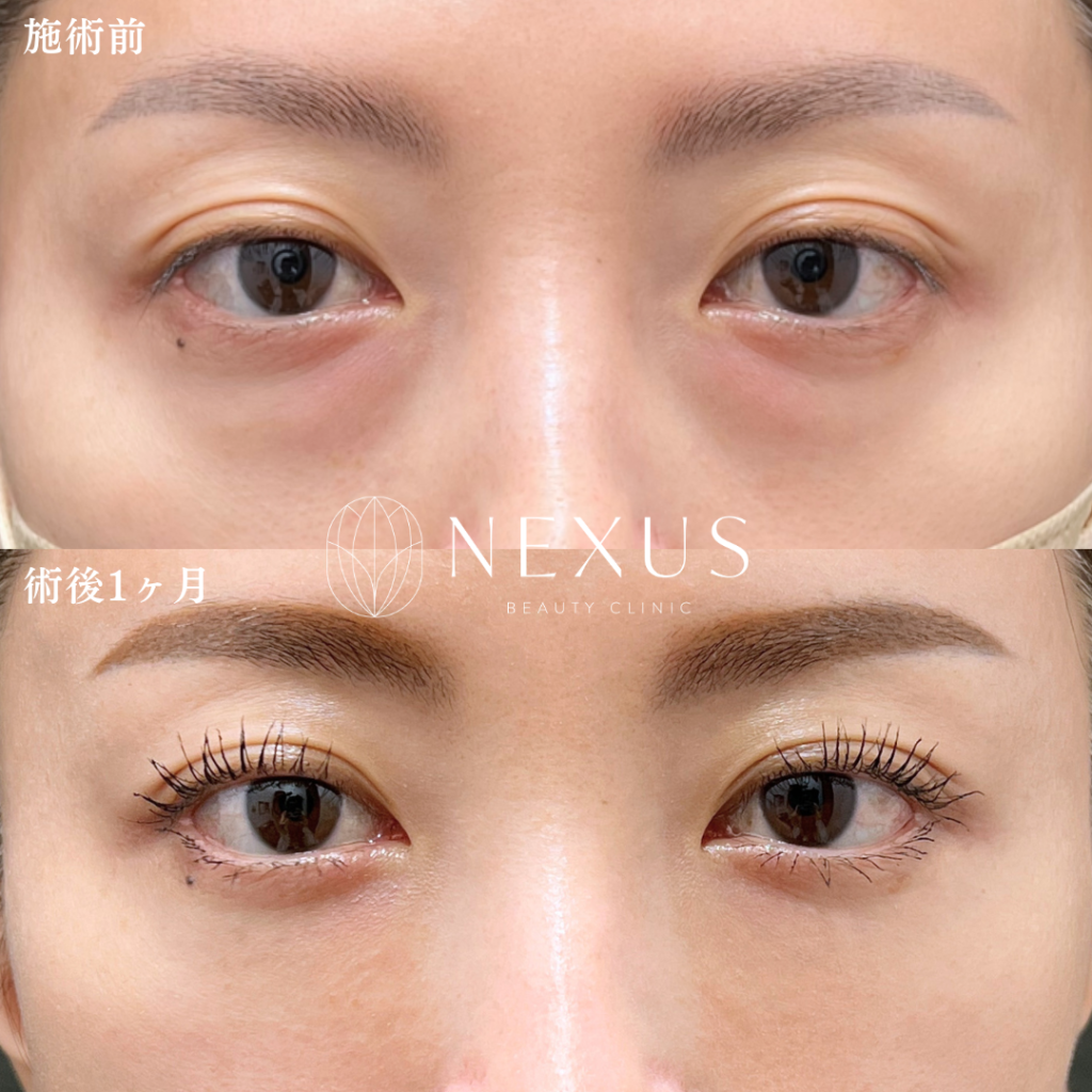 裏ハムラ＋脂肪注入 症例写真