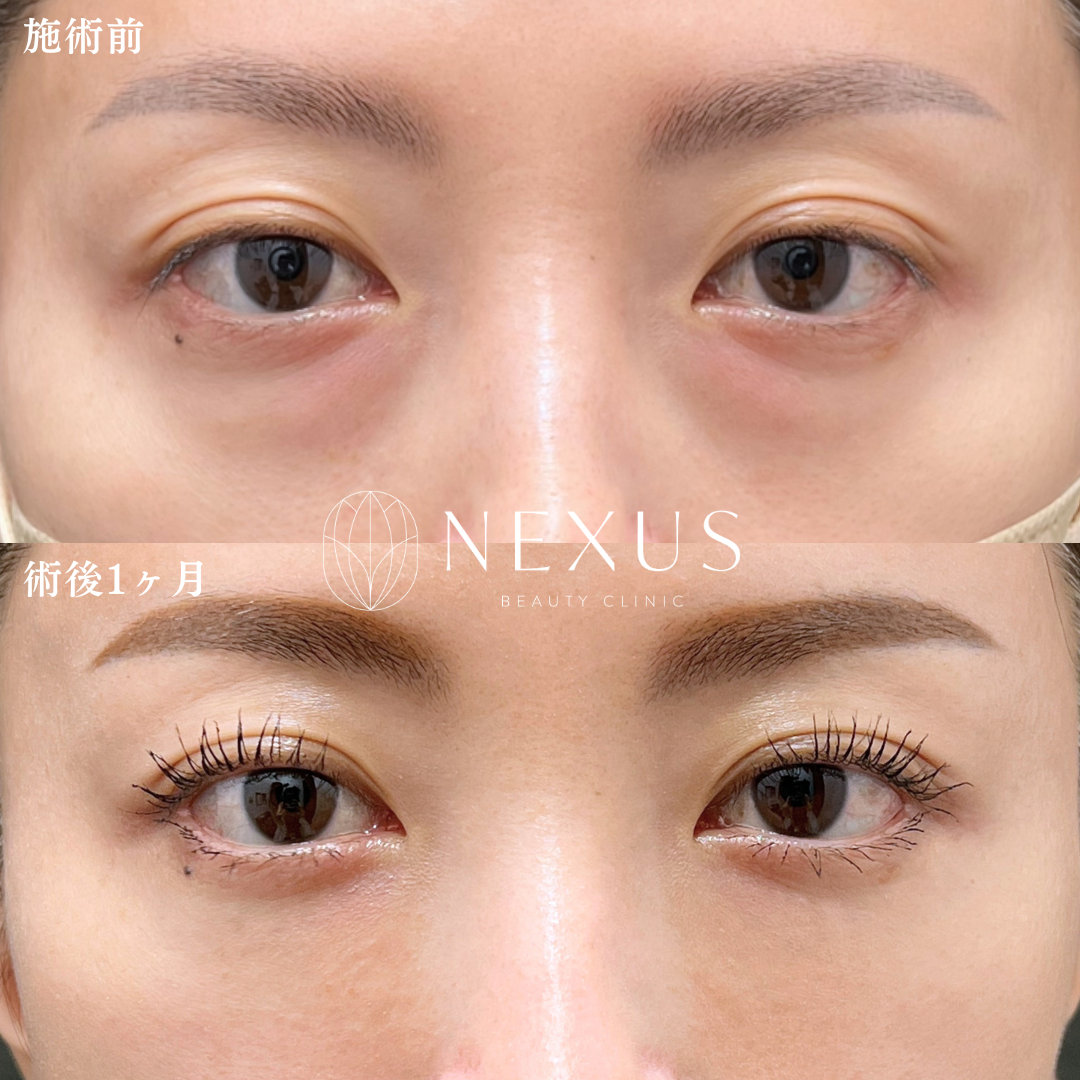 裏ハムラ ＋脂肪注入 症例写真