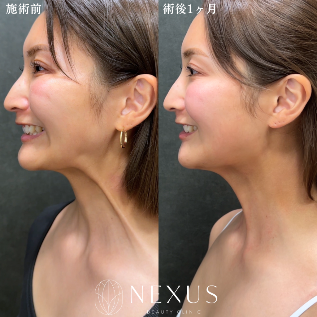 ボトックスリフト（中範囲）＋口角ボトックス