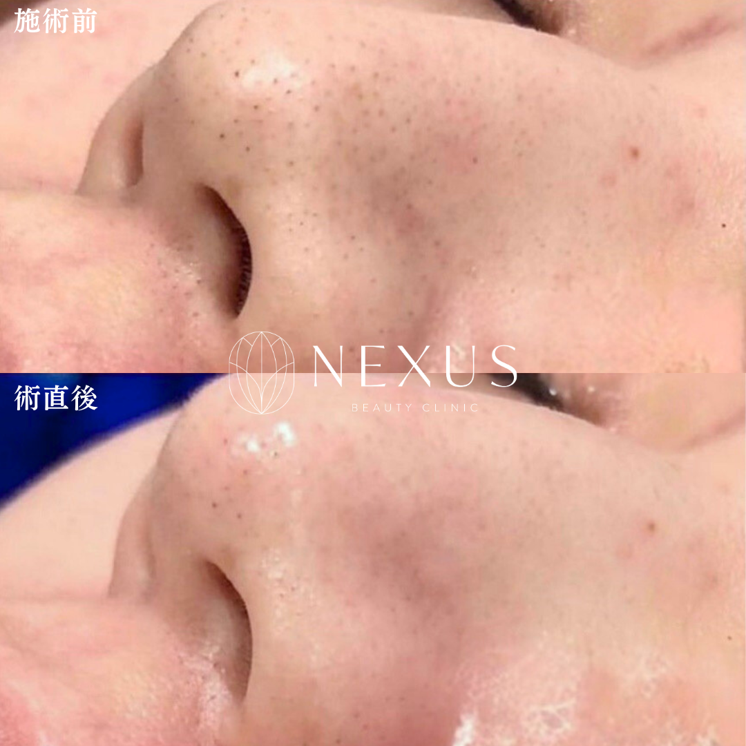ハイドラジェントル 症例写真