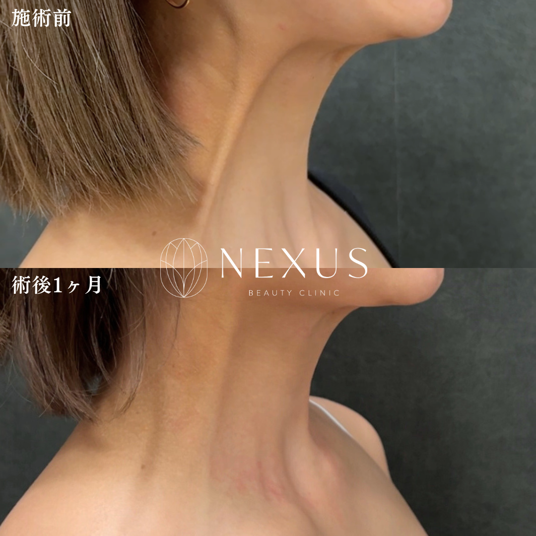 ボトックスリフト（中範囲）＋口角ボトックス 症例写真