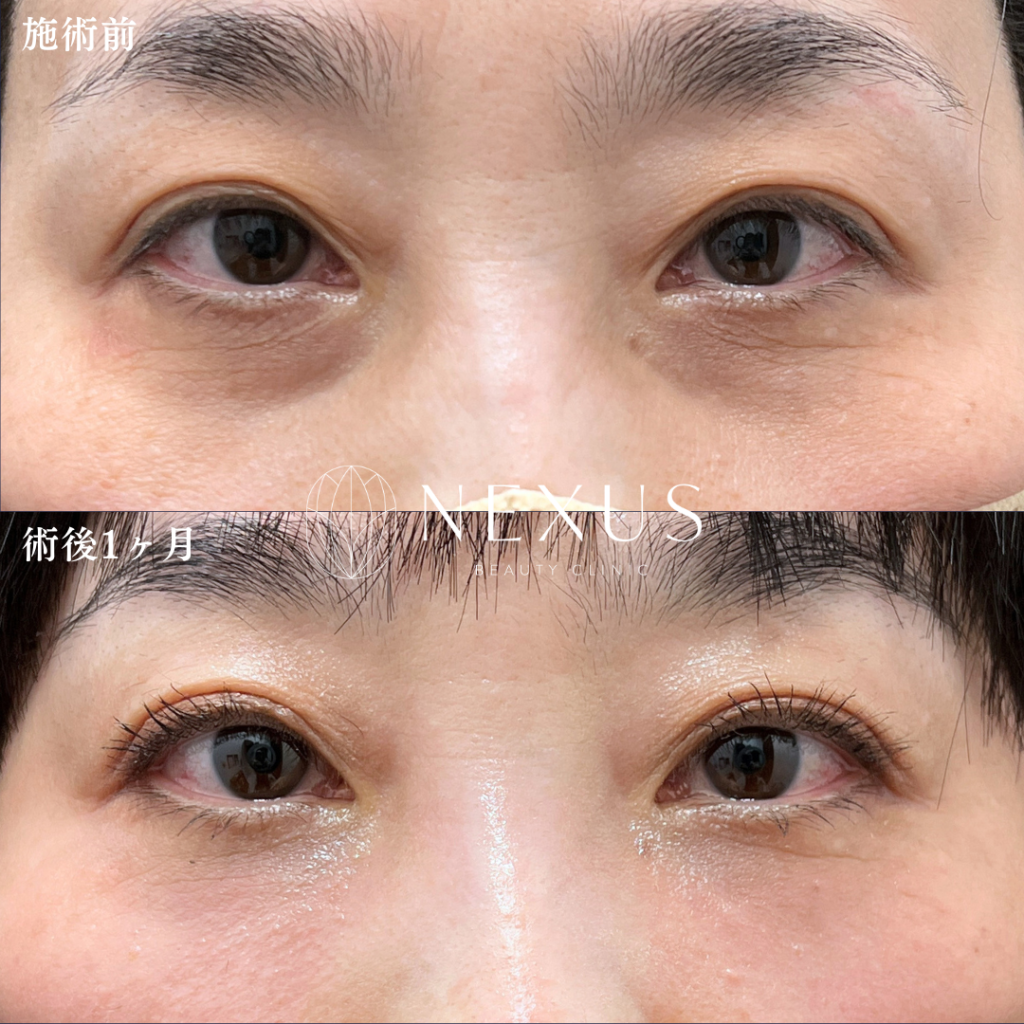 脂肪注入(目の下ゴルゴ)