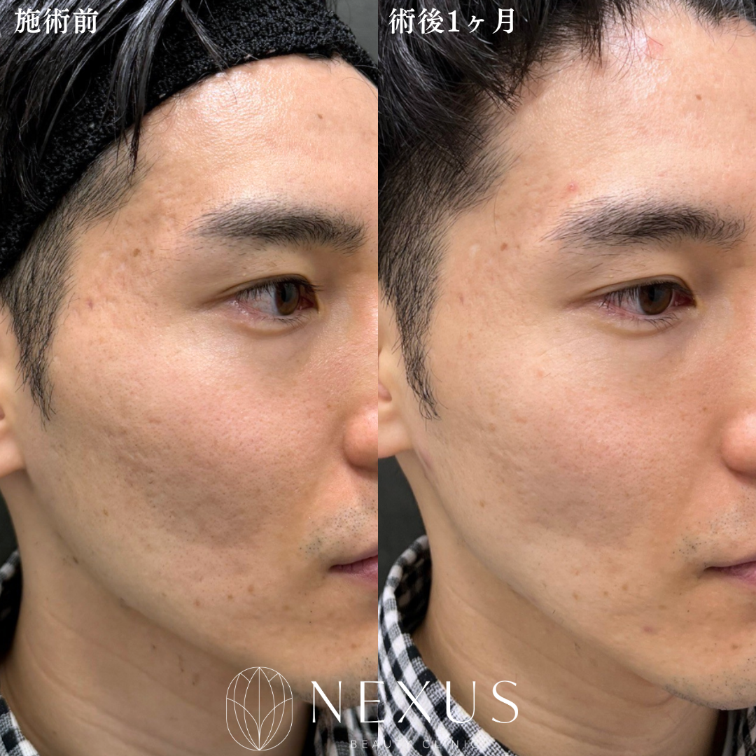 サブシジョン（やり放題）1回＋ジュベルック（Dr手打ち）1回 症例写真