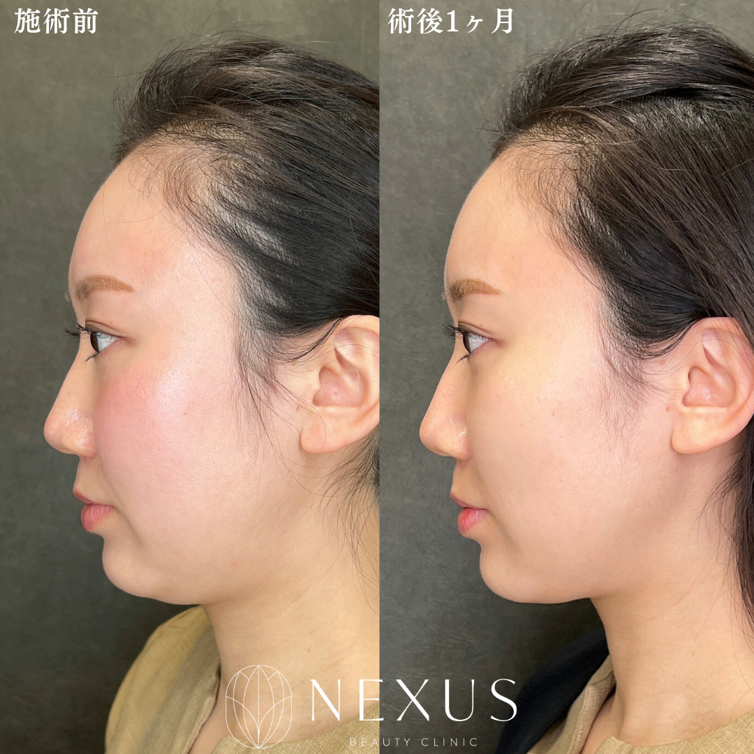 FatX core(顎下)5cc 症例写真