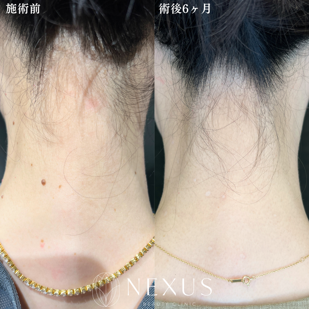 ほくろ(20個まで) 症例写真