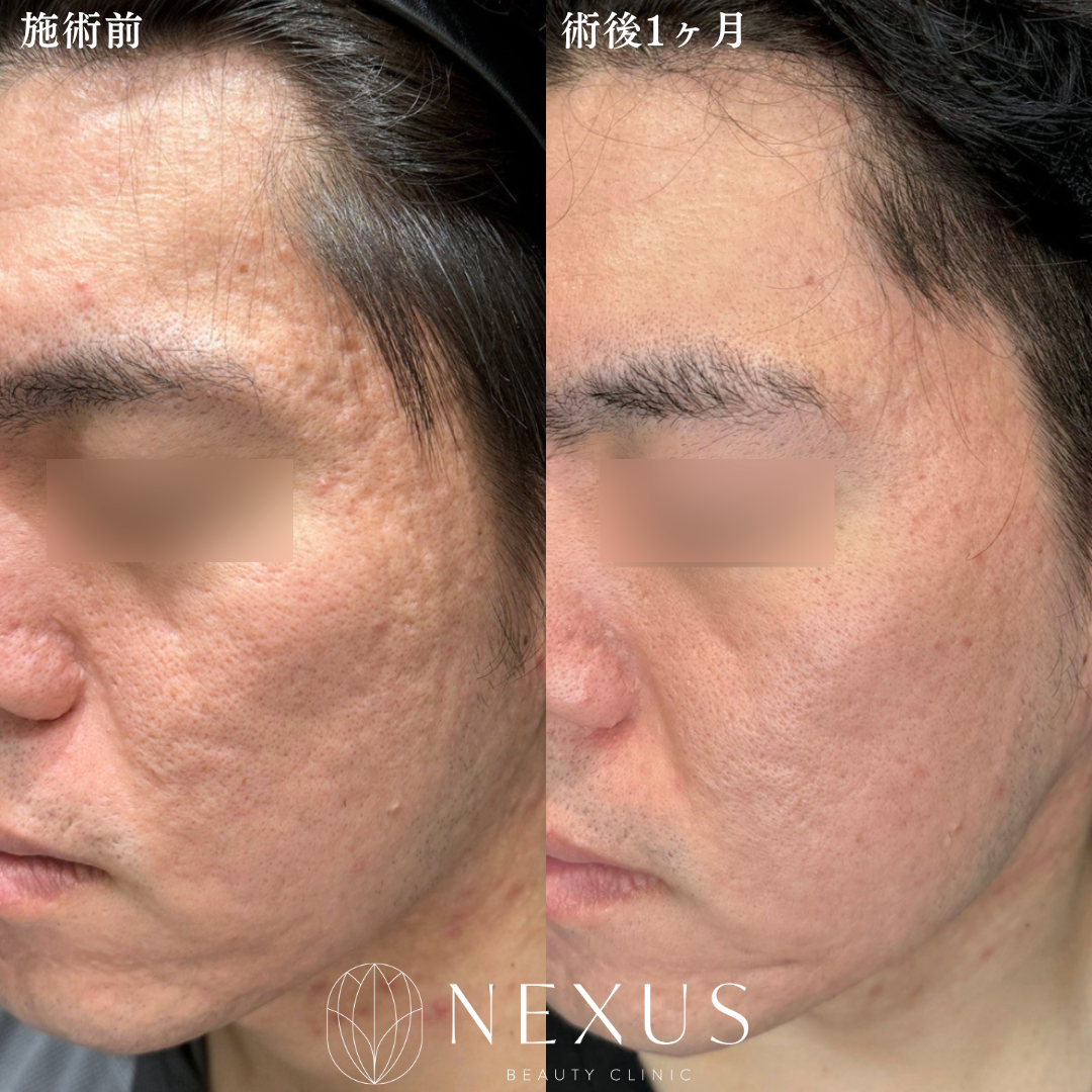 サブシジョン(やり放題)1回+TCAクロス(顔全体) 1回 +ジュベルック(Dr手打ち)1回 症例写真
