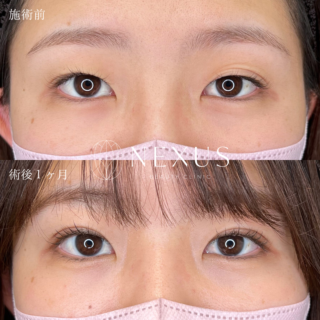 自然癒着法（韓国式二重埋没法） 症例写真