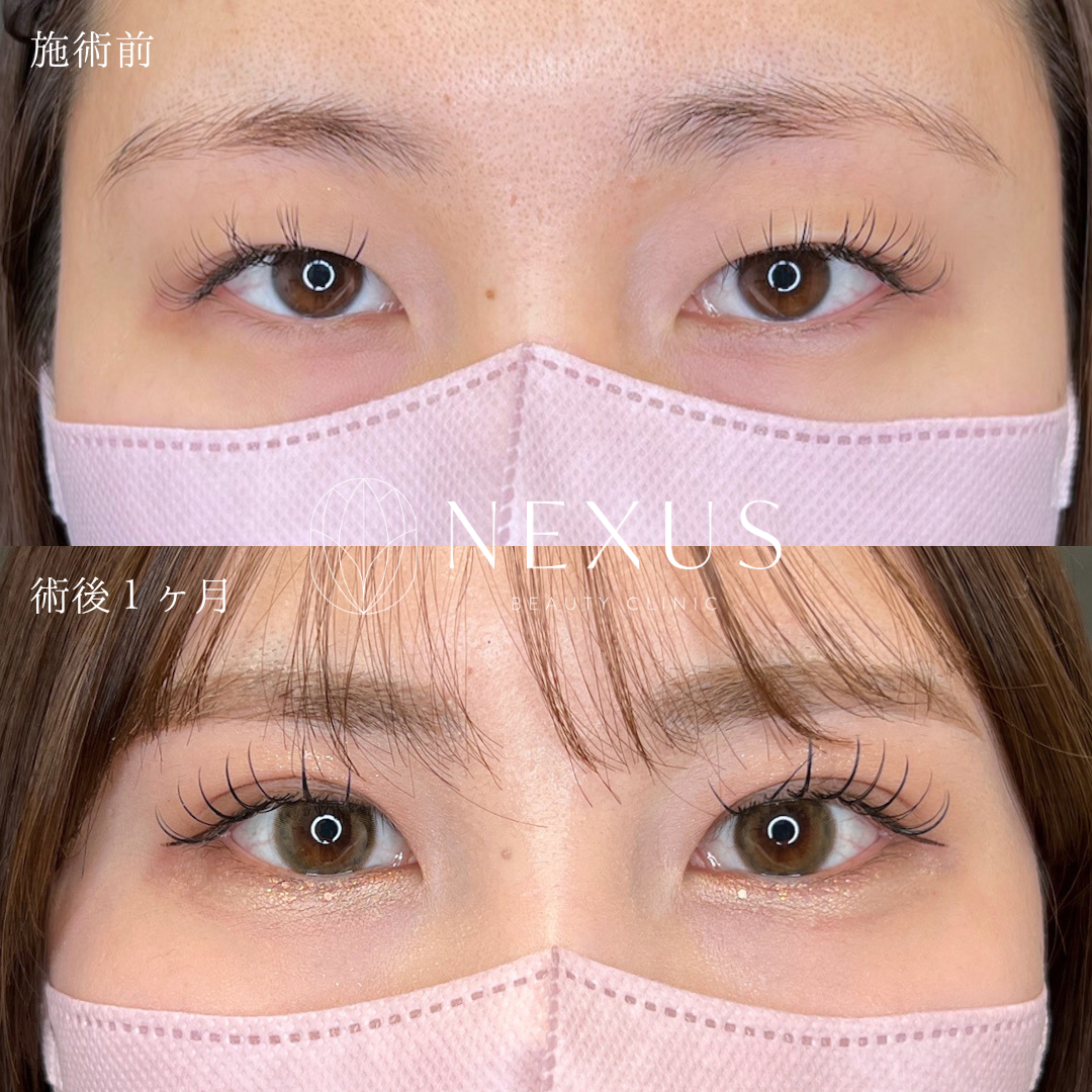 自然癒着法（韓国式二重埋没法） 症例写真