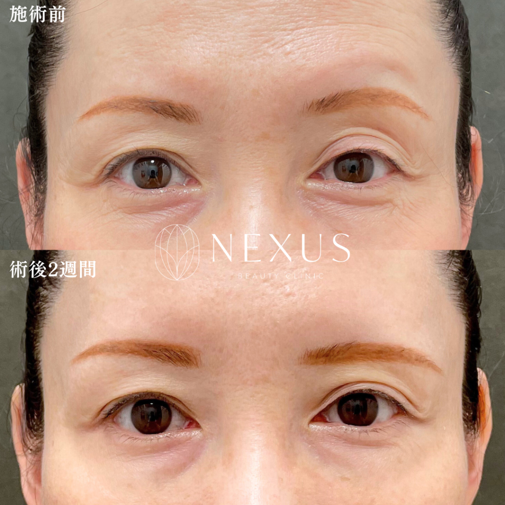 ボトックス(目の上)