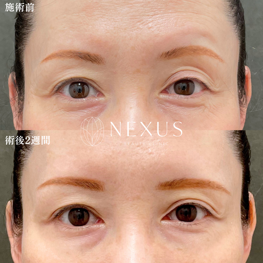 ボトックス(目の上) 症例写真