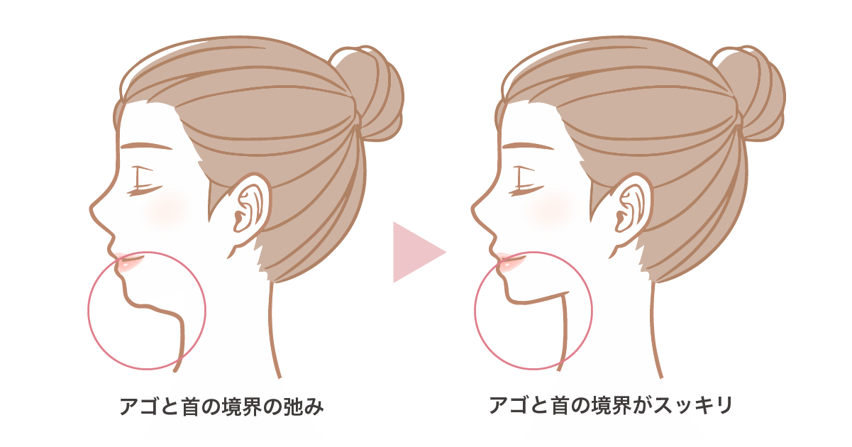 ペリカン手術（顎下筋肉縛り）