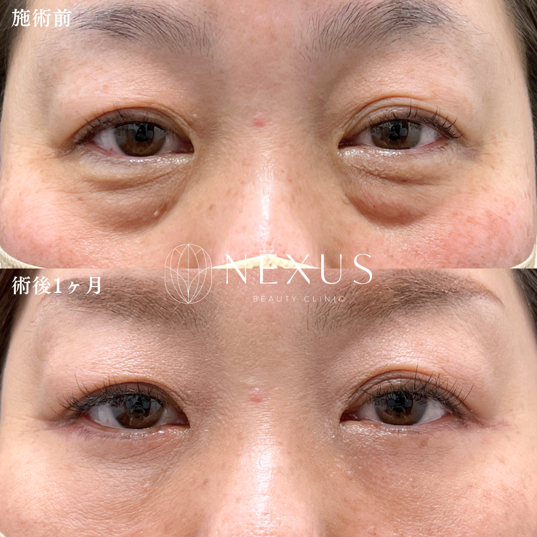 切開ハムラ＋脂肪注入 症例写真