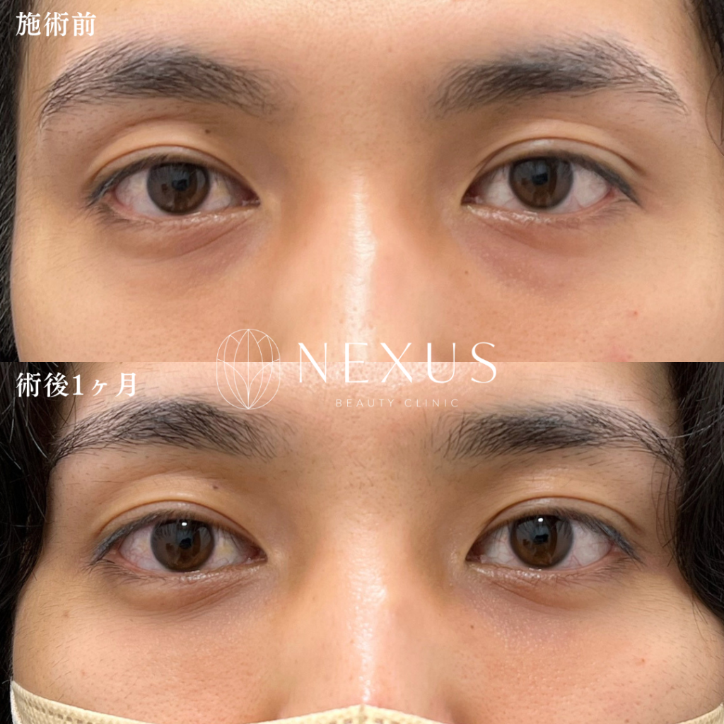 脱脂＋脂肪注入 症例写真