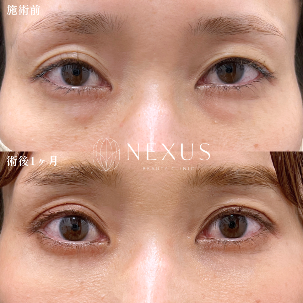 裏ハムラ＋脂肪注入 症例写真