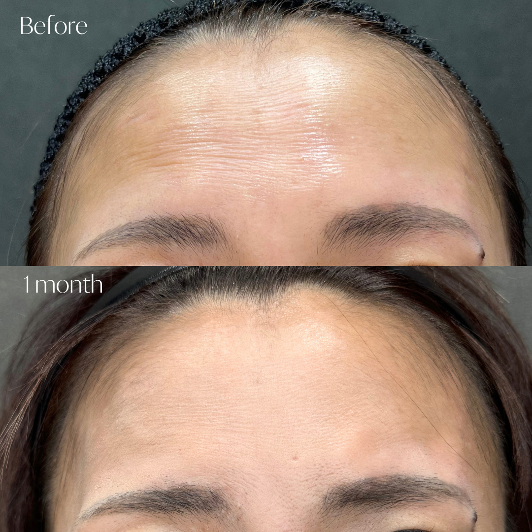 スキンバイブ(1cc) 症例写真