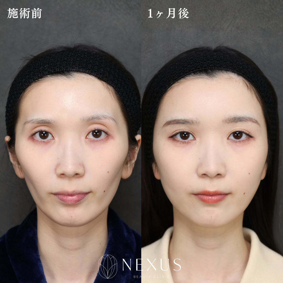 全顔脂肪注入（額・こめかみ・頬・目の上） 症例写真