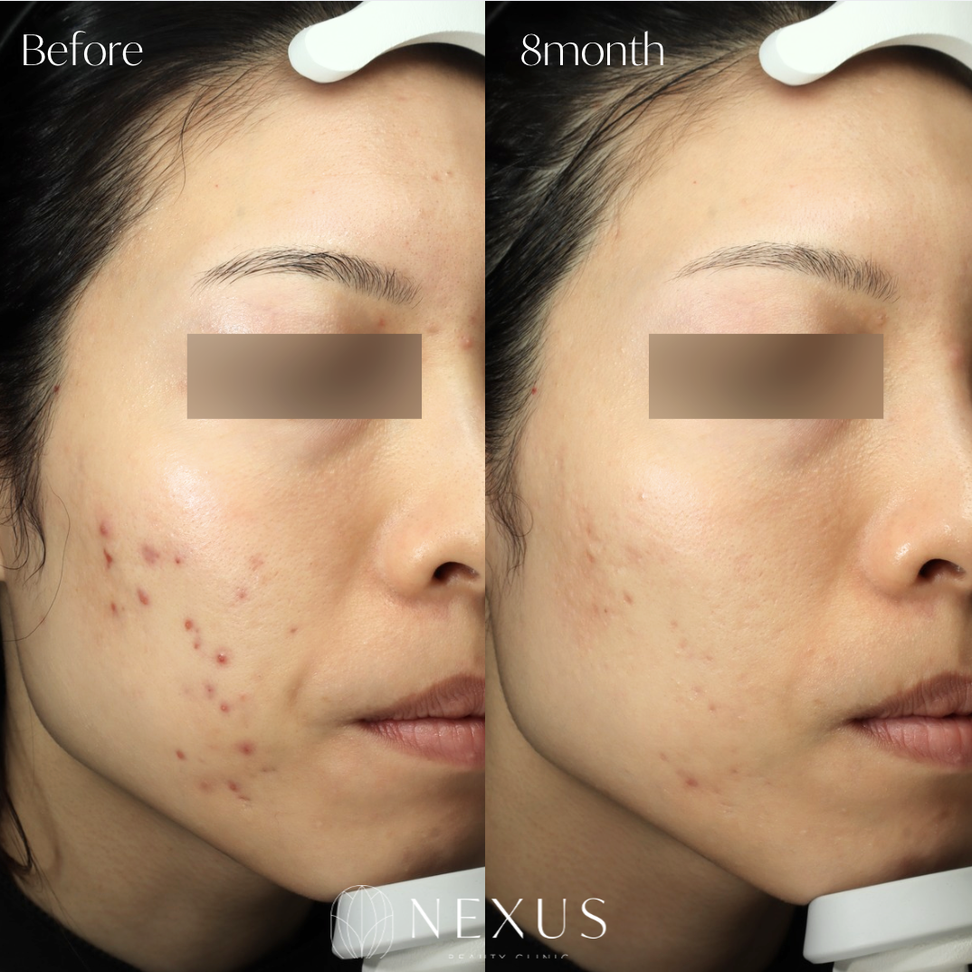 Wジェネシス 症例写真