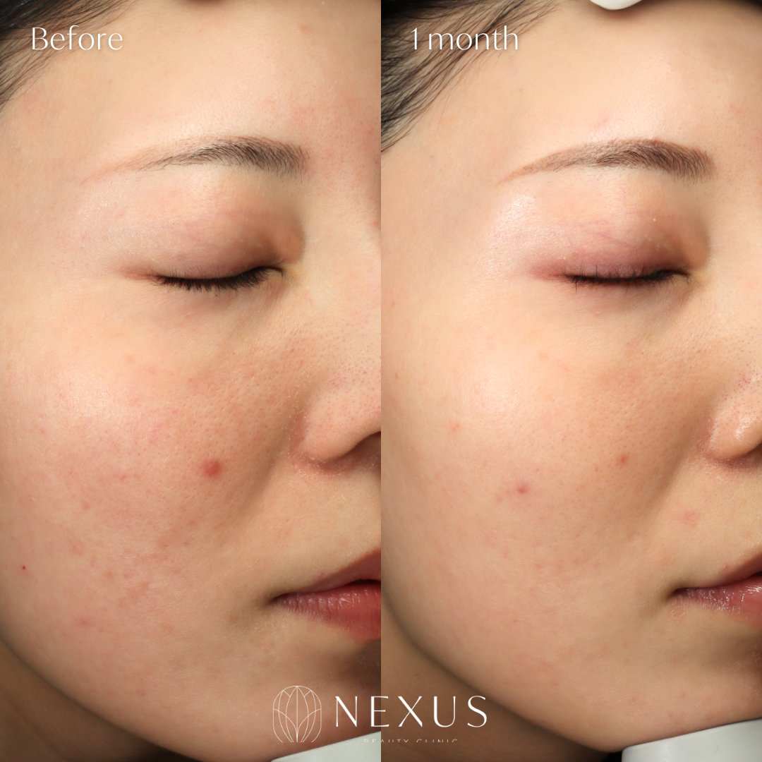 Vホワイト 症例写真