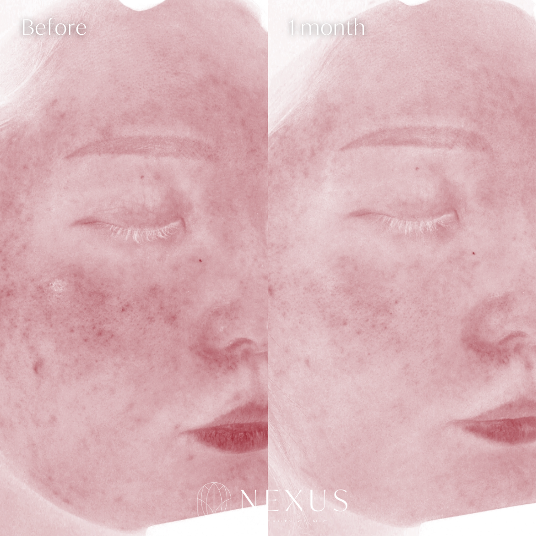 Vホワイト 症例写真