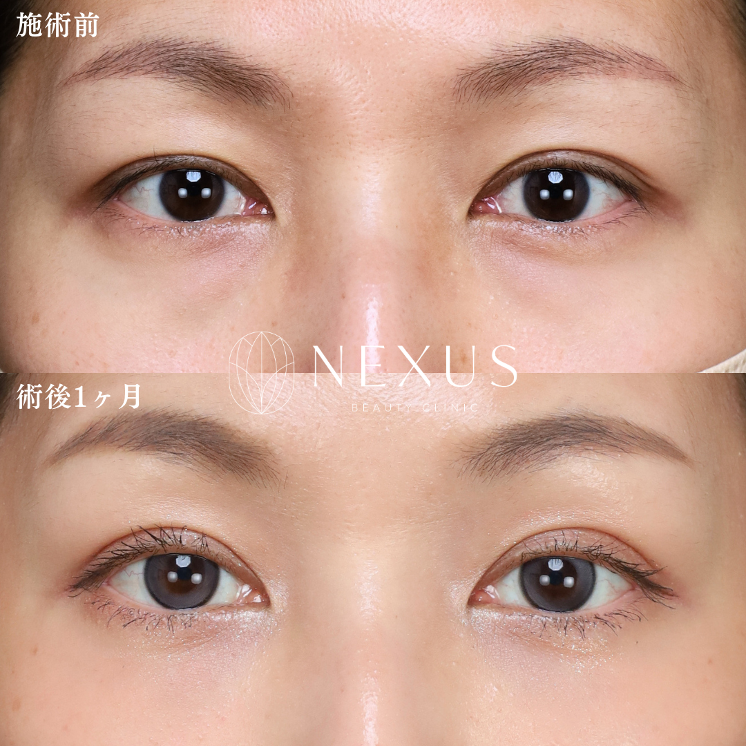 脱脂＋脂肪注入 症例写真