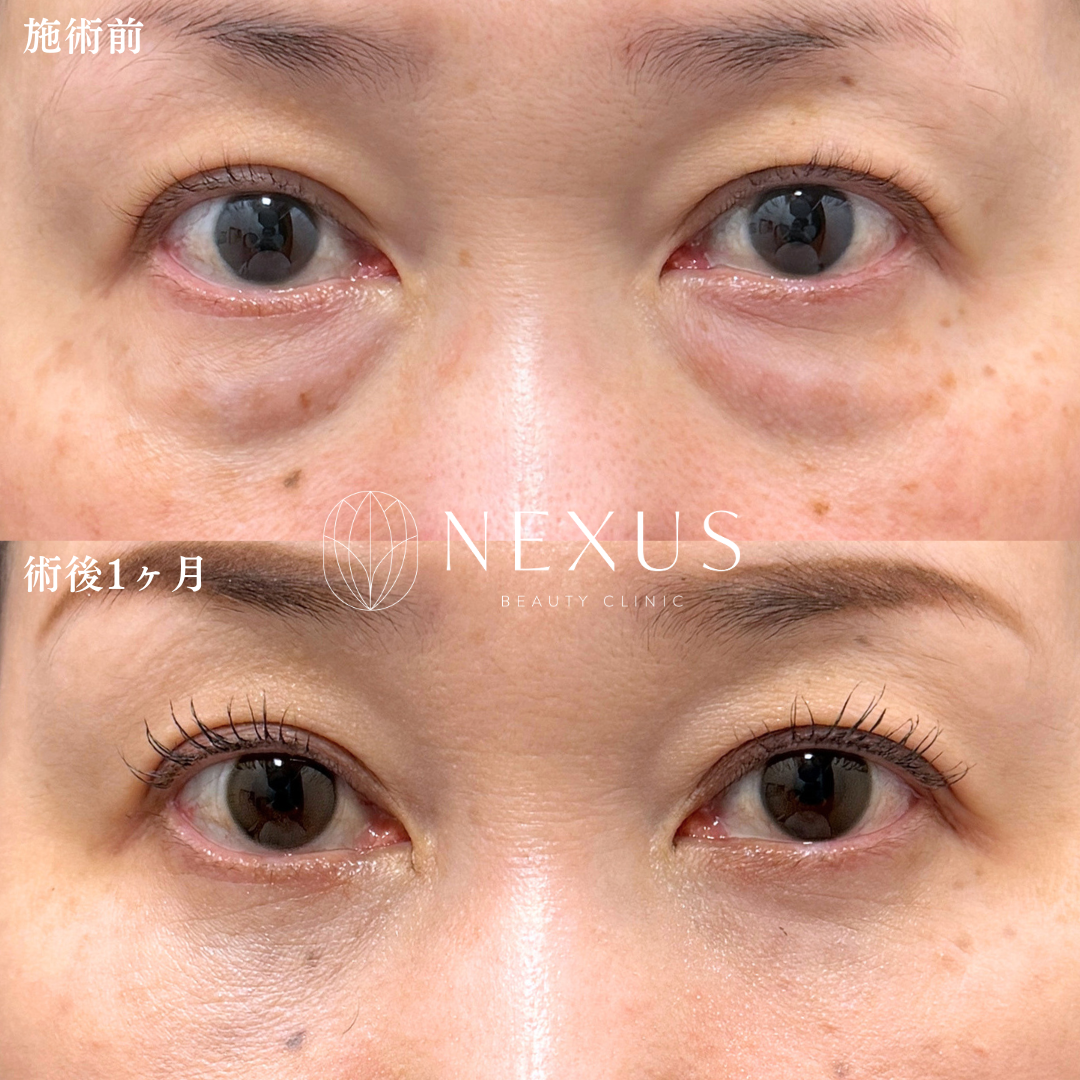 脱脂＋脂肪注入 症例写真
