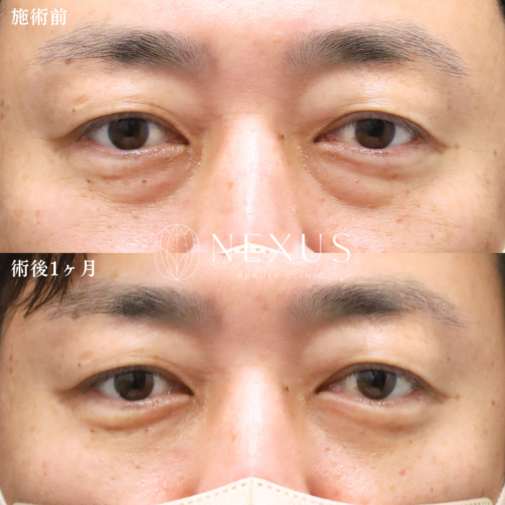 裏ハムラ 症例写真