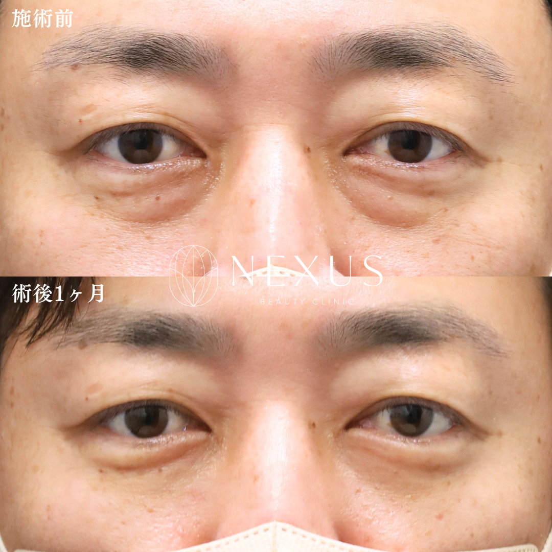 裏ハムラ 症例写真