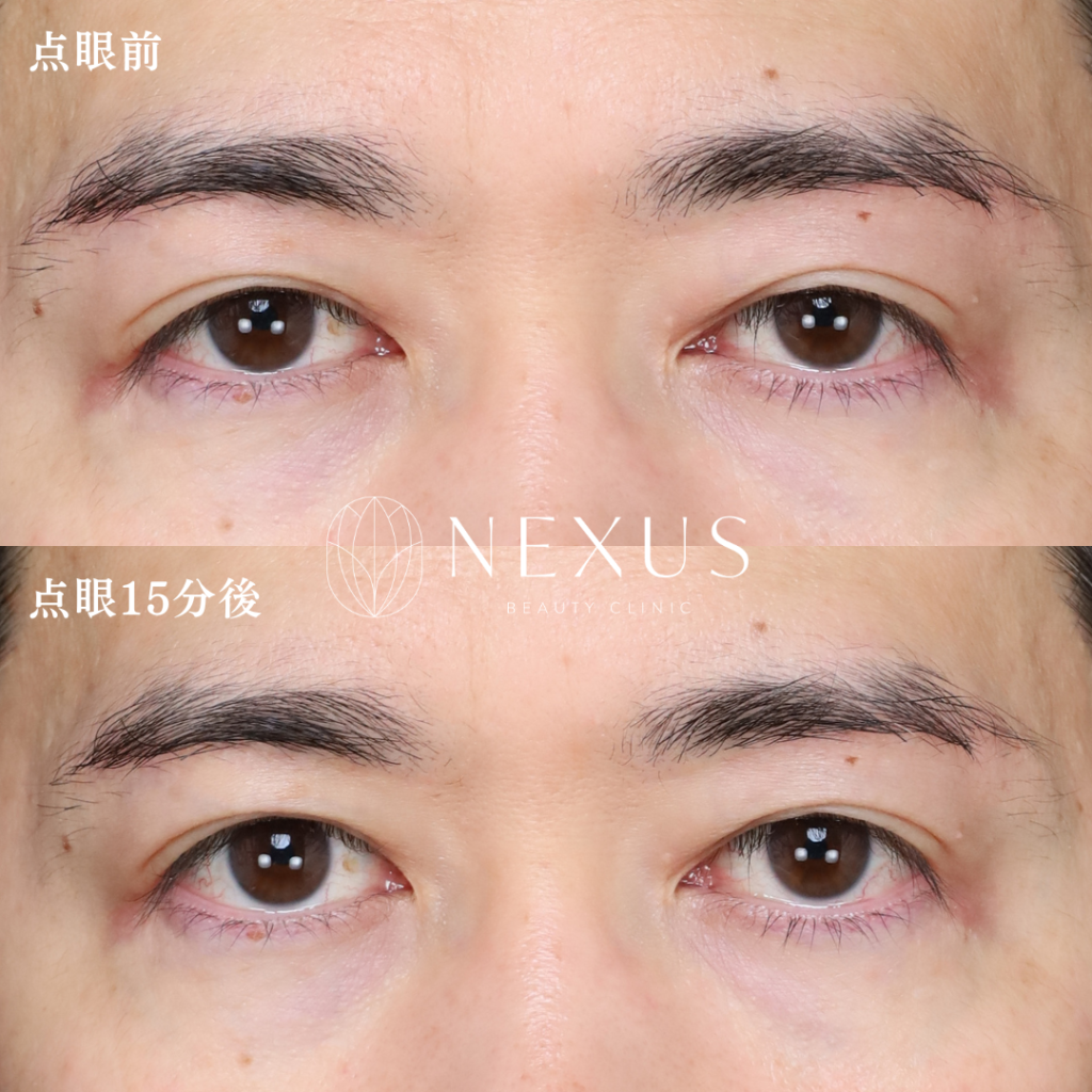 アップニーク点眼薬