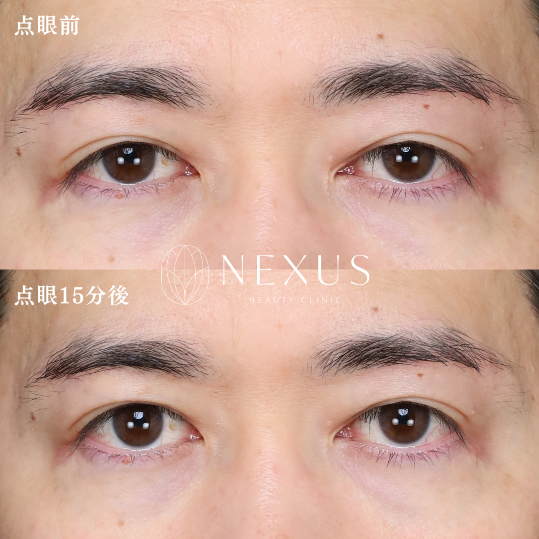 アップニーク点眼薬 症例写真