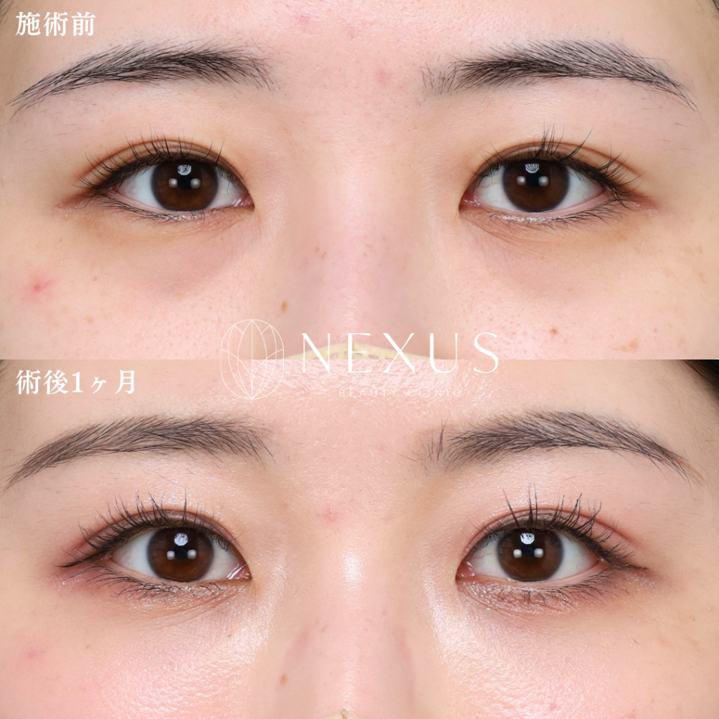 裏ハムラ＋脂肪注入 症例写真