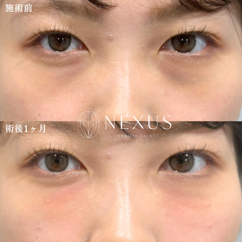 Quickくま取り注射 症例写真