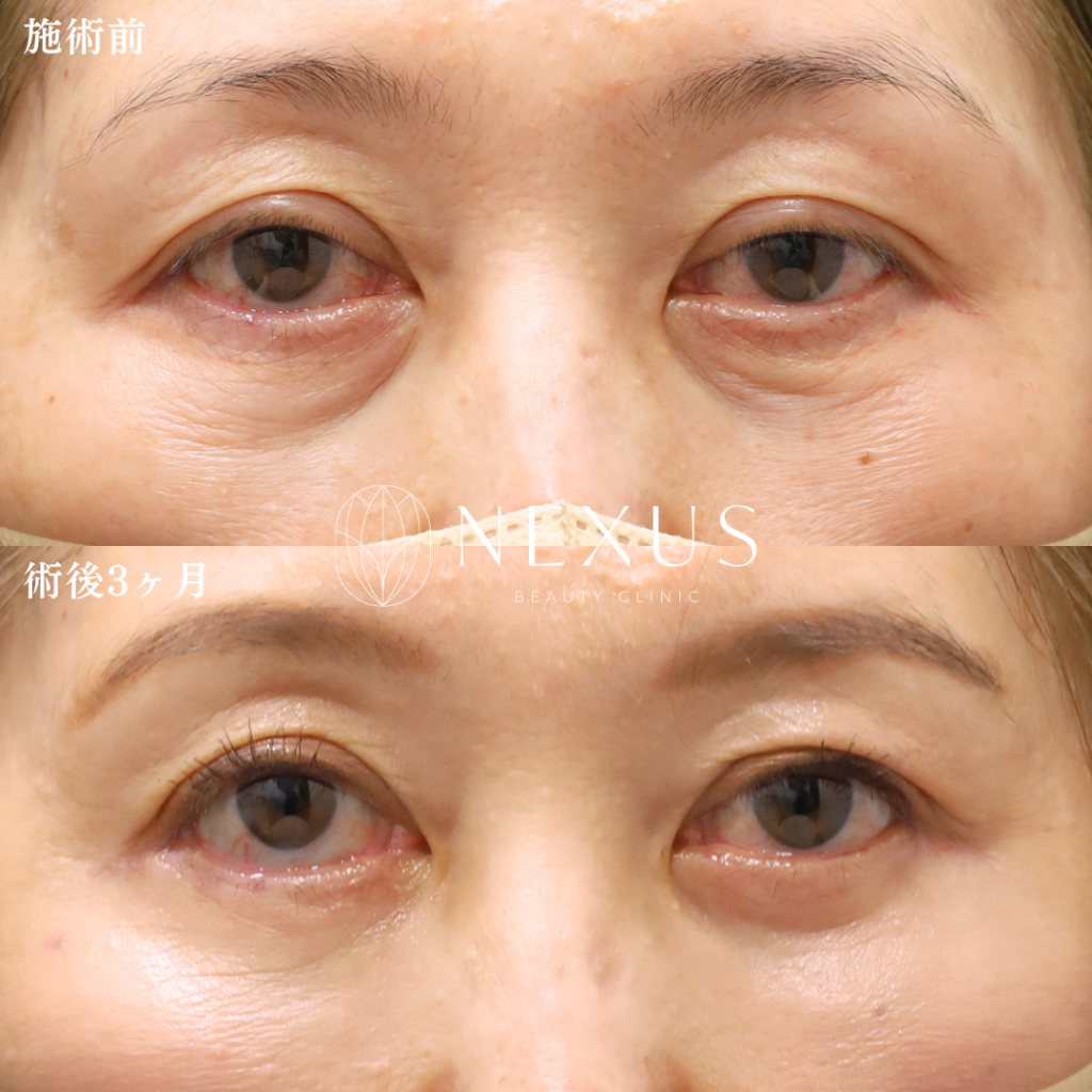 切開ハムラ＋脂肪注入 症例写真